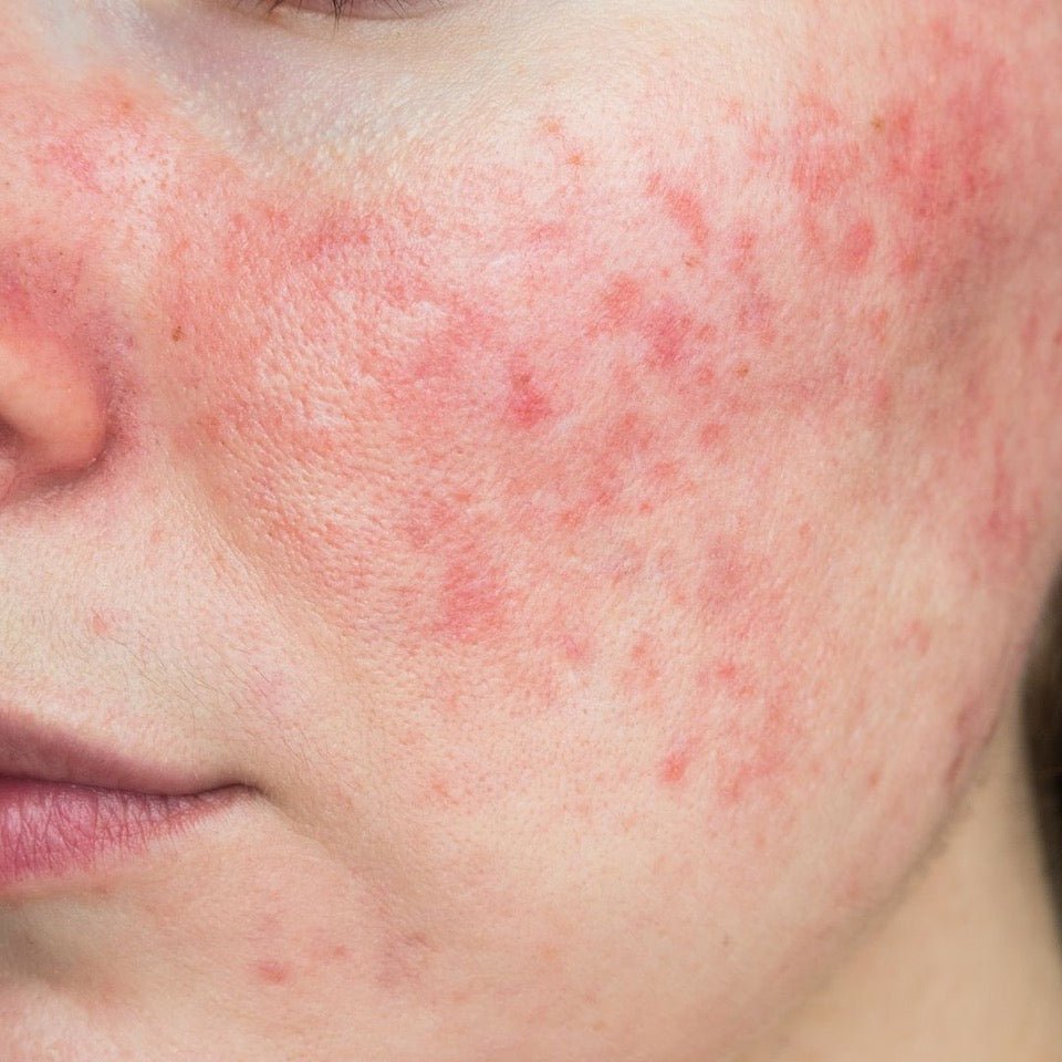 What’s your problem: Rosacea - Eco By Sonya Europe